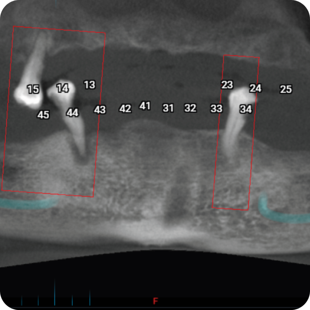 Are dental Xrays safe? Toronto Dental Clinic