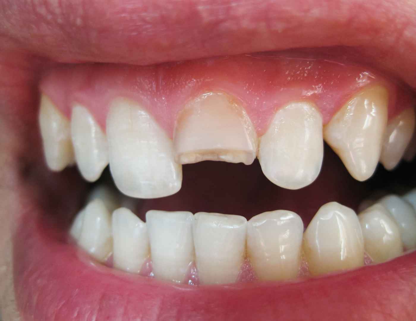 Chipped Tooth Repair