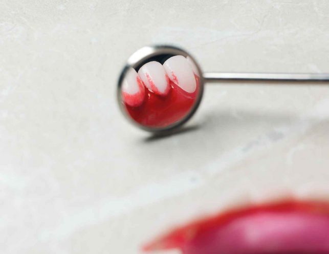 bleeding gums Causes