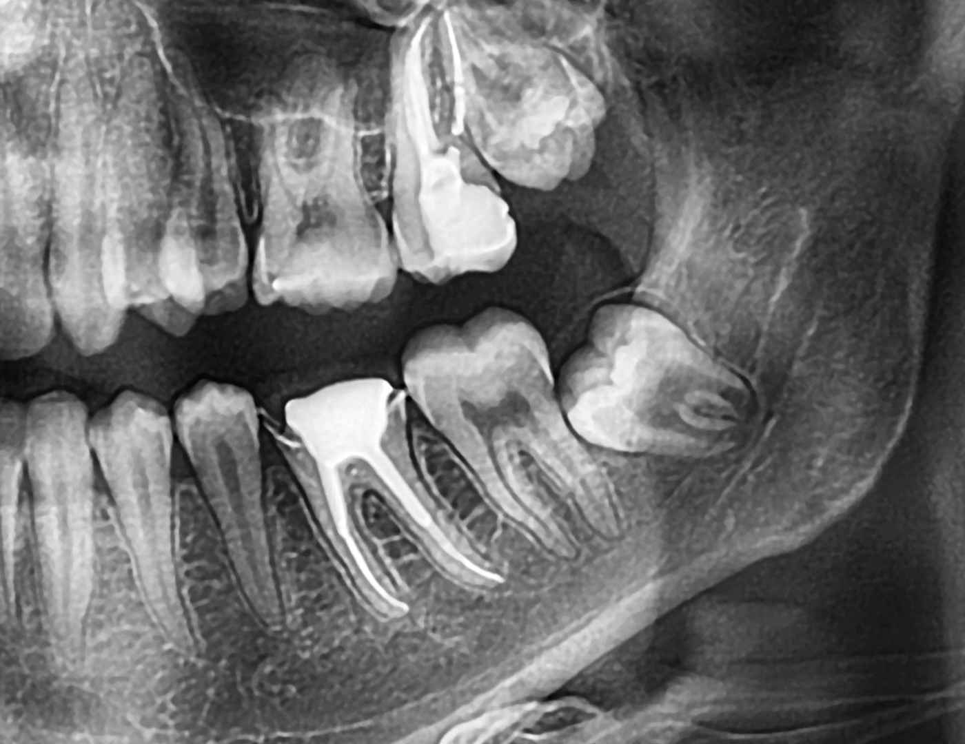 Wisdom Teeth Removal surgery