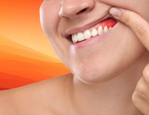 Types of Tooth Abscesses Explained