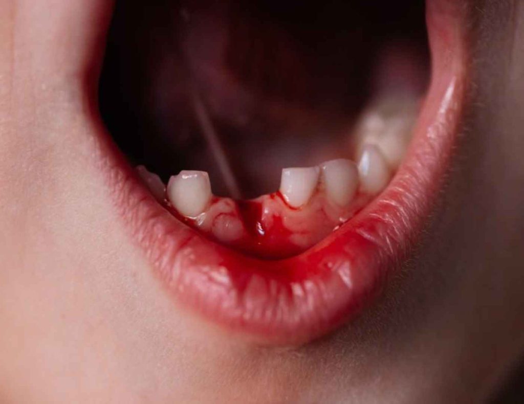 Children Bleeding Gums 