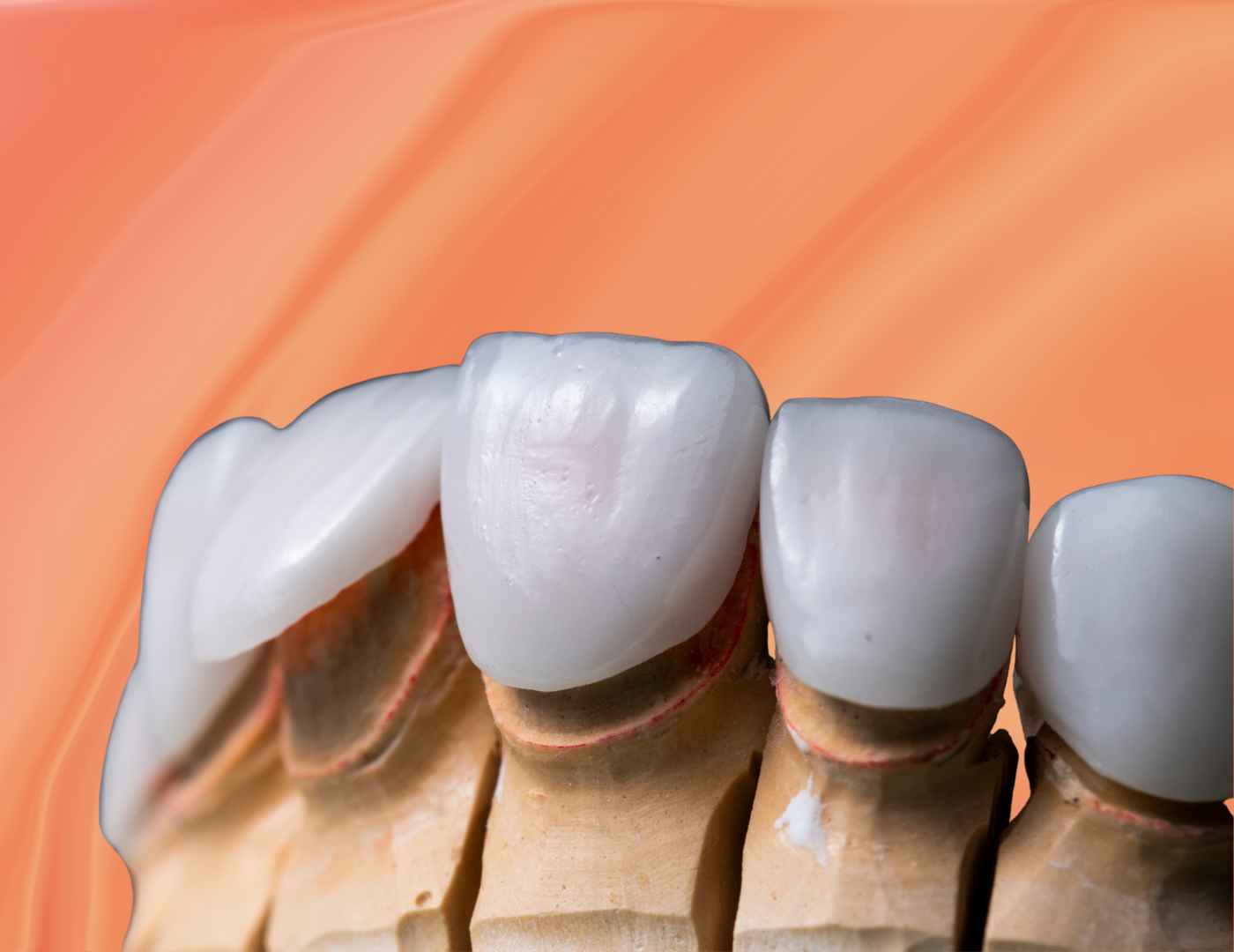 What Happens to Teeth Under Veneers